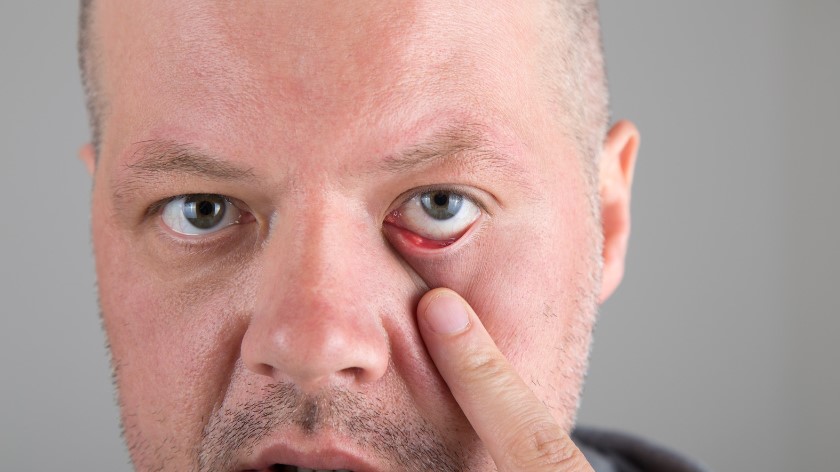 How to Get Rid of a Stye?