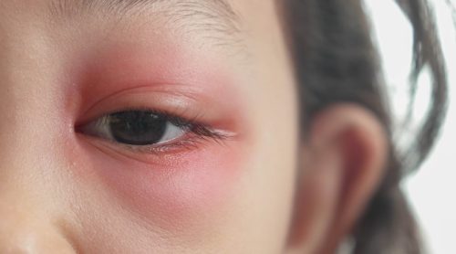How to Get Rid of a Stye?