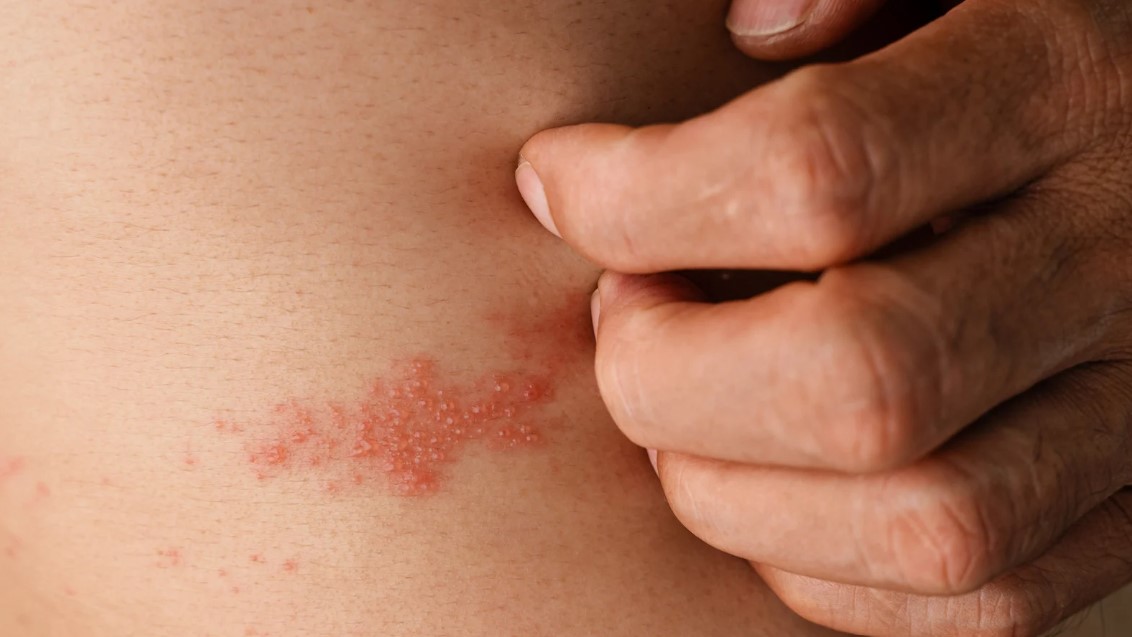 How to Cure Shingles in 3 Days?