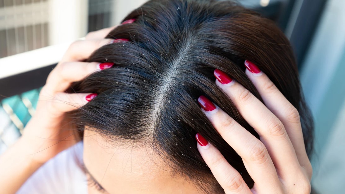 How to Get Rid of Dandruff?