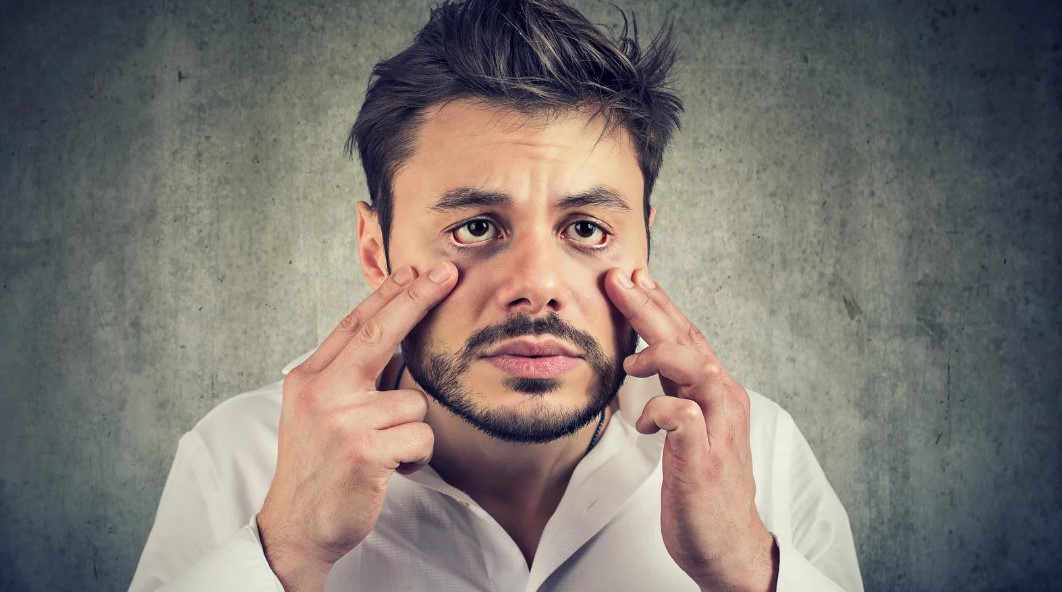 How to Get Rid of Eye Bags?