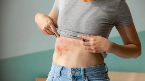 How to Cure Shingles in 3 Days?