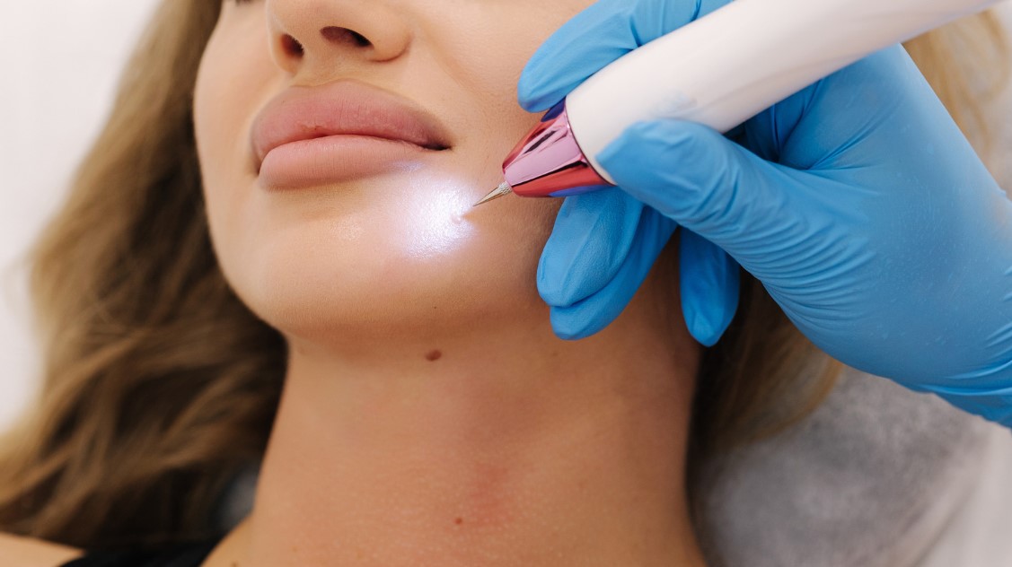 how to get rid of warts